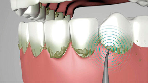 Recambios Starlyf Ultrasonic 3 en 1
