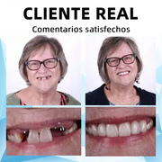 Prótesis Dental de Silicona | Sonrisa Instantánea