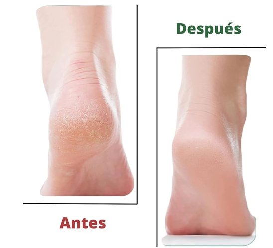 Quita cayos para pies suaves | ViamoMas