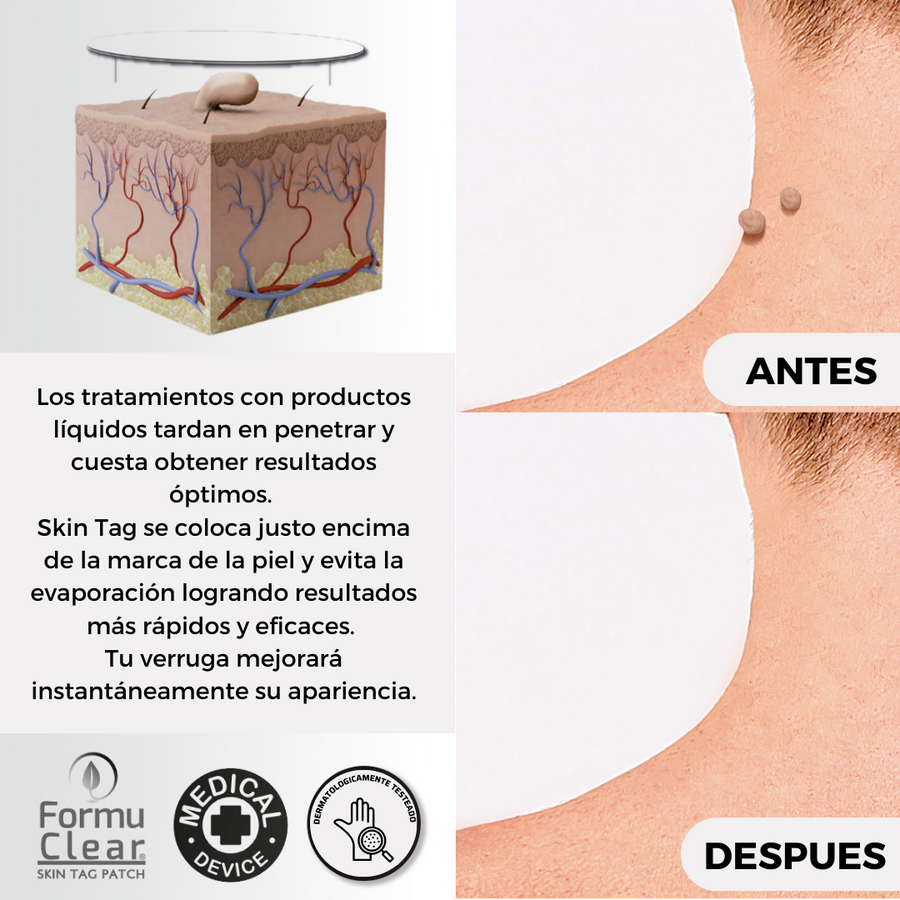Parches para verrugas sin dolor | ViamoMas