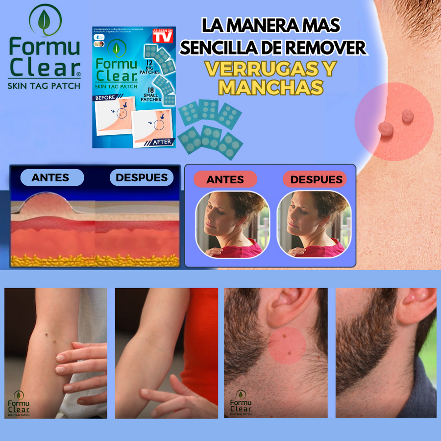 Parches para verrugas sin dolor | ViamoMas