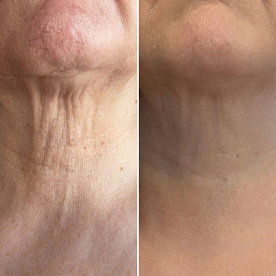 Masajeador antiarrugas cuello y rostro 3D