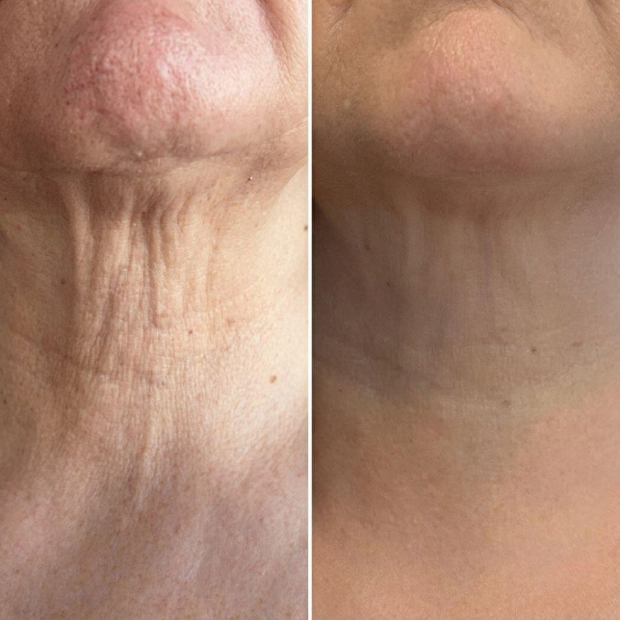 Masajeador antiarrugas cuello y rostro 3D